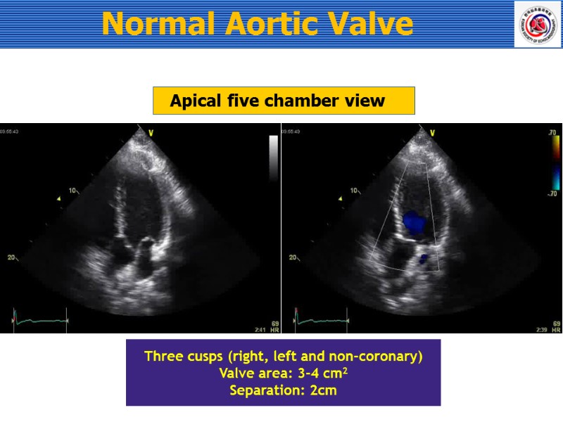 Apical five chamber view Three cusps (right, left and non-coronary) Valve area: 3-4 cm2
